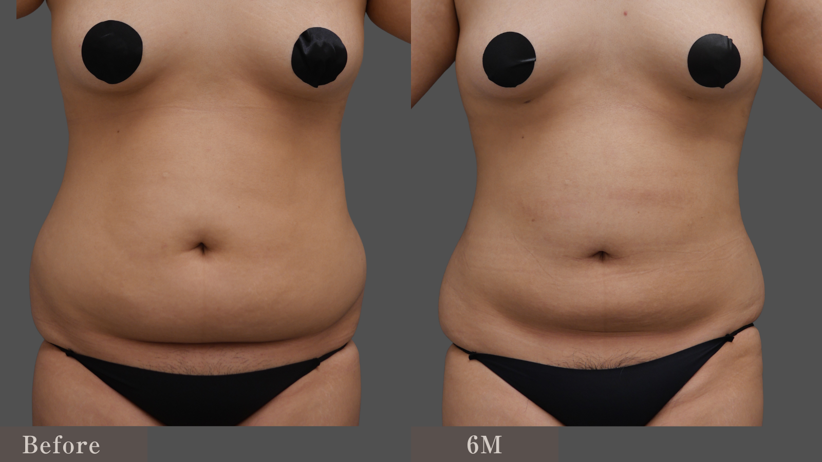 綺麗なお腹になりました