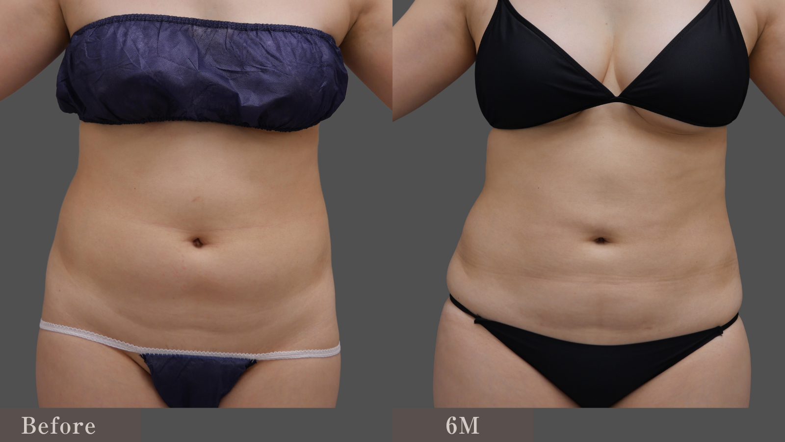 お腹周り、すっきりしました。