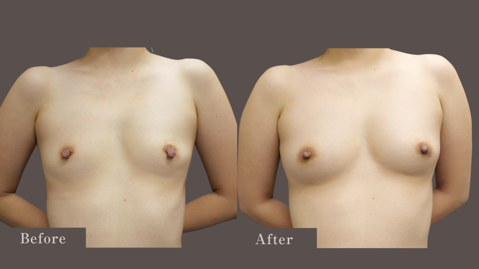 コンデンスリッチ豊胸と乳頭縮小でバスト若返り