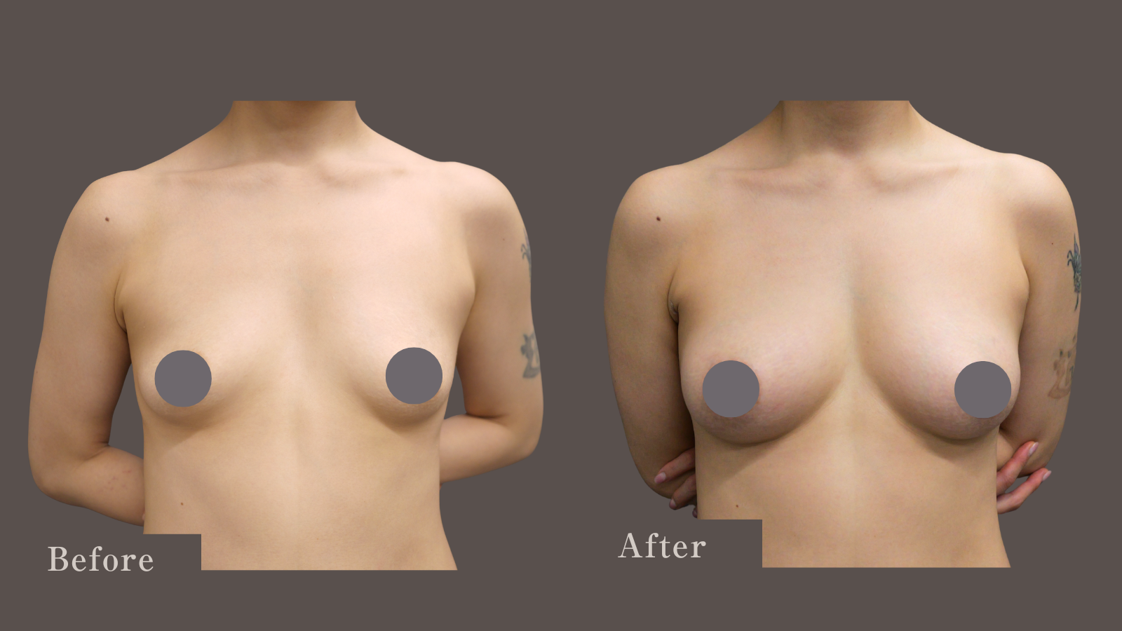 美しくバストアップしました