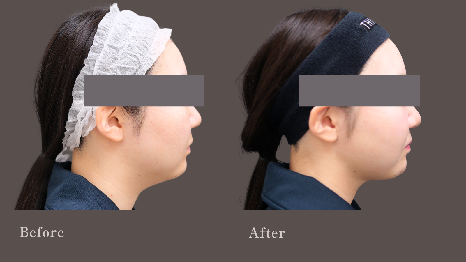 小顔吸引で整いました