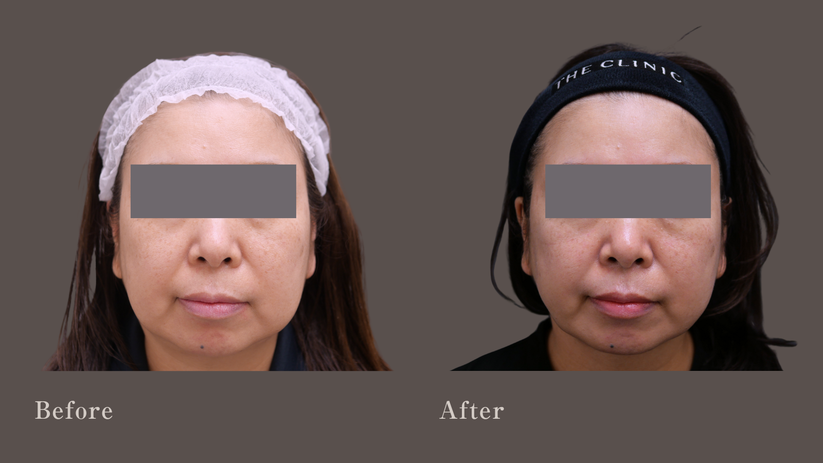 50代の小顔吸引