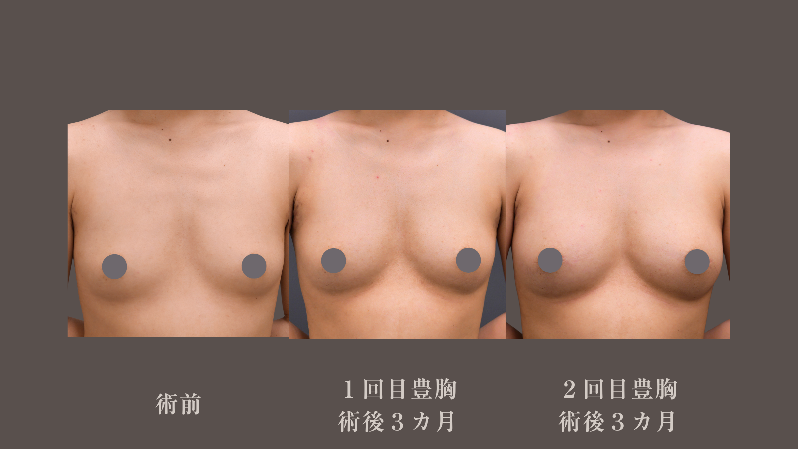 脂肪豊胸２回で大きなバストになりました