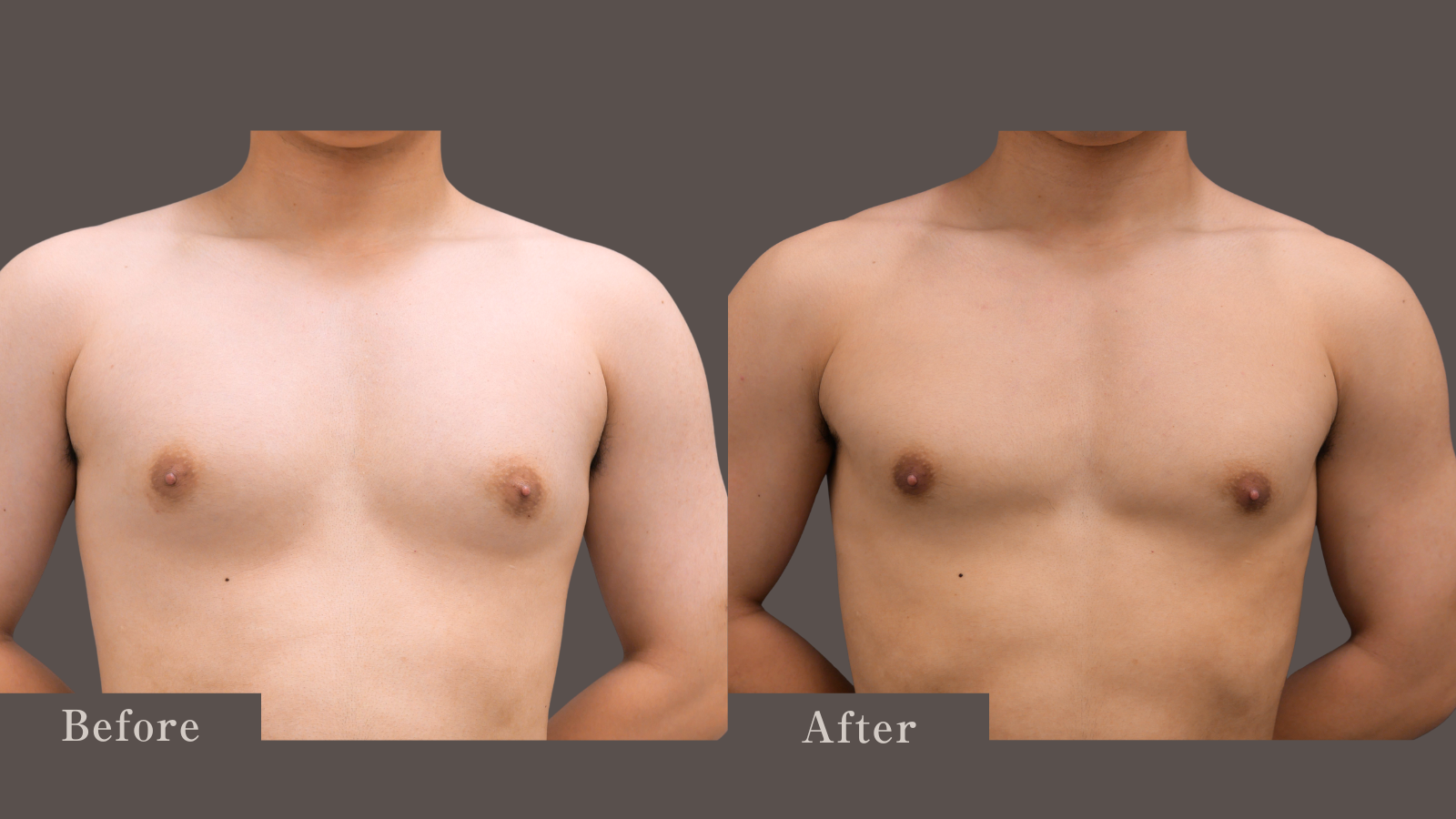 胸部脂肪吸引で男性的な大胸筋に仕上げました